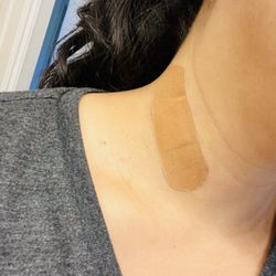 John How, MD - The How Clinic - Tiny band-aide post procedure. Easy peasy!