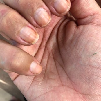 Sky Nails Spa - Nail damage post gel manicure. You can see the line from where they filed - Waxing Near Me - Jacksonville, Florida