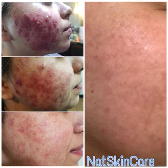 NatSkinCare - Skin Care Near Me - Las Vegas, Nevada NatSkinCare - Skin Care Near Me - Las Vegas, Nevada