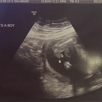 Karanzan Baby Imaging - Today 5/17 we were told by someone else it's a boy - Ultrasound Imaging Centers Near Me - Salida, California
