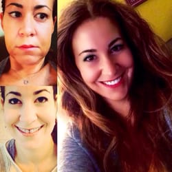 Batastini Frank DMD - Photos:  Ten days post surgery, then post expansion with braces, and now post treatment.