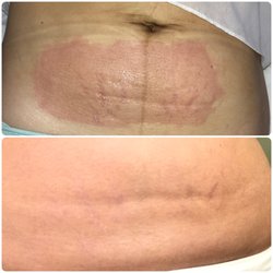Before (upper picture) and after (lower) of my stretch marks reduction after 2 treatments