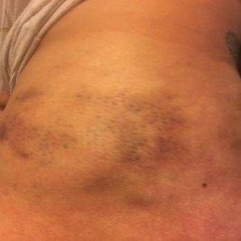 Shirley McWilliams Acupuncture - Thera Cane bruising, after use due to pain - Acupuncture Near Me - Fresno, California