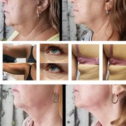 katydid it aesthetics - Laser Lift
