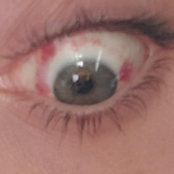 LasikPlus - Left eye, 1 day after Lasik. - Optometrists Near Me - Paramus, New Jersey