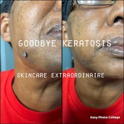 The Skincare Extraordinaire  - Keratosis, Fibromas, skin tags.... 1 treatment and they are gone!