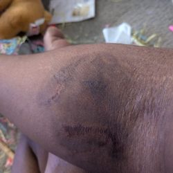 This is what my arm looks like 2 weeks after