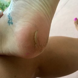No fricken go! Paid for the most expensive callus removal and they didn't even remove it. No fricken go! Paid for the most expensive callus removal and they didn't even remove it.