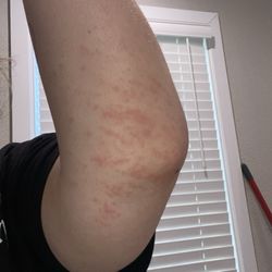 40s & Shortys - Rash or possibly chemical reaction. Be aware not sure how sanitary that bar is.