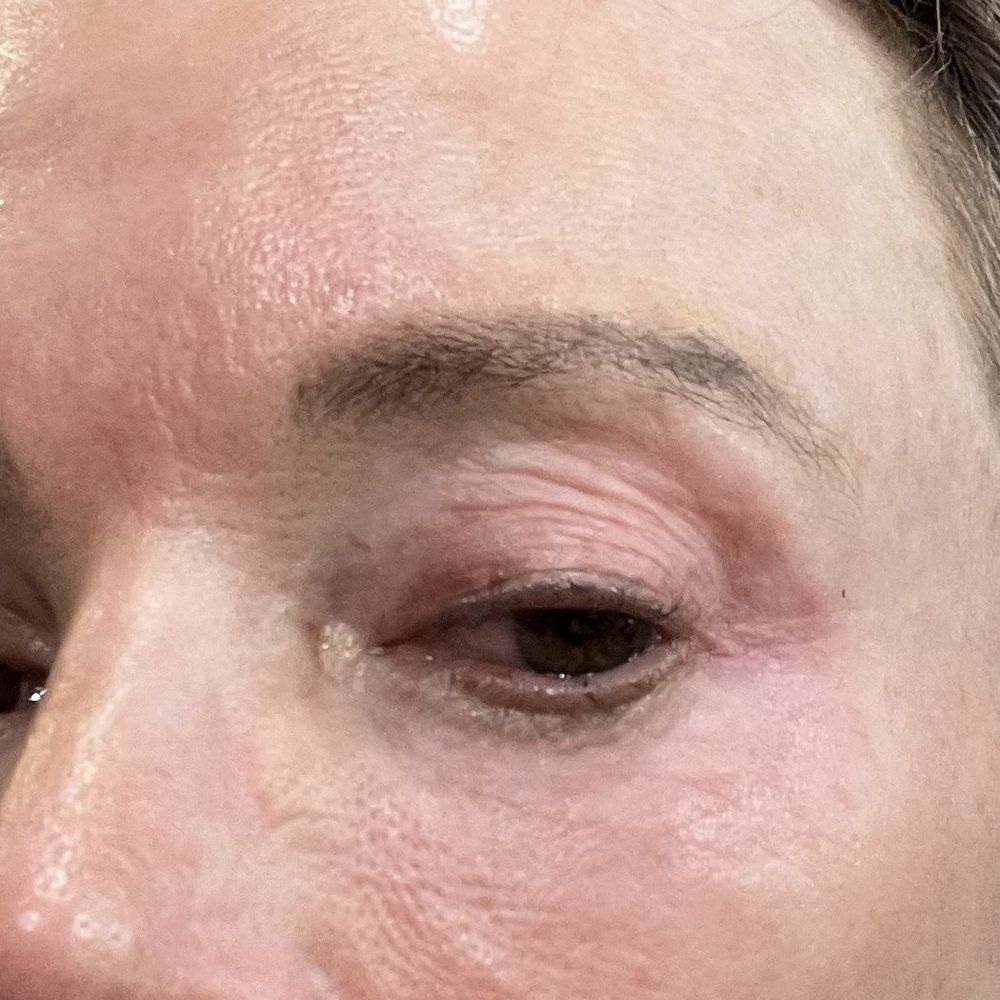 Kenneth Bermudez, MD - Prolonged red on eye - Less then right but will have to have future treatments to resolve . - Medical Spas Near Me - San Francisco, California