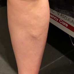 BEFORE seeing Dr. Ellen Derrick, bulging veins on the front of my leg showed up after I had my second baby. BEFORE seeing Dr. Ellen Derrick, bulging veins on the front of my leg showed up after I had my second baby.