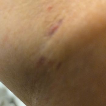 Lakeside Hospital - 5 pokes for a vein. One arm. - Hospitals Near Me - Omaha, Nebraska Lakeside Hospital - 5 pokes for a vein. One arm. - Hospitals Near Me - Omaha, Nebraska