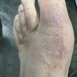 The Foot and Ankle Center - Toe after stitches were removed.