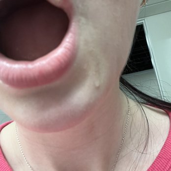 ProSmiles Dental - Blister from the assistants tool - General Dentistry Near Me - Naperville, Illinois ProSmiles Dental - Blister from the assistants tool - General Dentistry Near Me - Naperville, Illinois
