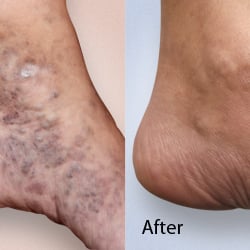 Advanced Varicose Vein Treatments of Manhattan - Spider Veins/ Foam schlerotherapy/ Dr. Lev