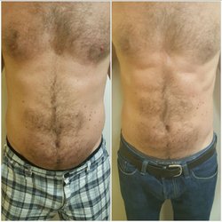 Results Weight Loss & Med Spa - Fat loss in 3 Ultimate LED Light sessions