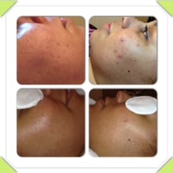Real Results Skin Care Therapy - She had "tried everything" to control acne! Then she found a Face Reality cert. pro @ Real Results Skin Care - has been clear for 5 years!