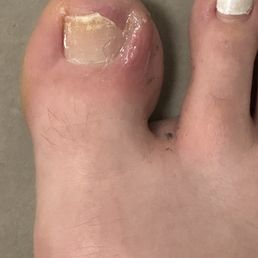 Toenail after doctor Toenail after doctor