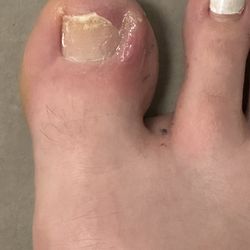 Exotic Nails - Toenail after doctor