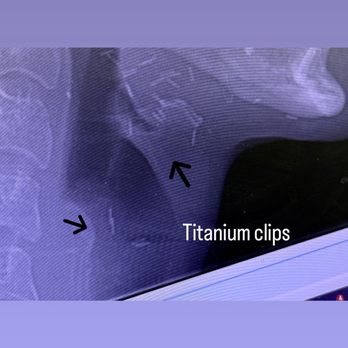 Sherber+rad - Titanium clips in my neck post surgery - Cosmetic Surgeons Near Me - Washington, DC, District of Columbia Sherber+rad - Titanium clips in my neck post surgery - Cosmetic Surgeons Near Me - Washington, DC, District of Columbia
