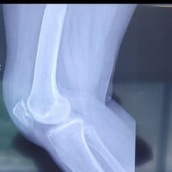 Matthew Zapf, MD - Desert Care Network Primary & Specialty Care - Communited patella fracture week 6 out.
