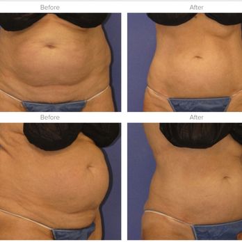 Coolsculpting Experts - Coolsculpting Cooltone - Weight Loss Centers Near Me - Scottsdale, Arizona Coolsculpting Experts - Coolsculpting Cooltone - Weight Loss Centers Near Me - Scottsdale, Arizona