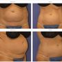 Photo of Coolsculpting Experts