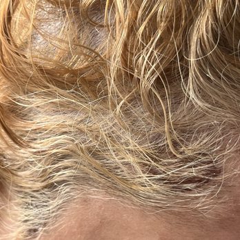 Elie Tanous Salon - Scalp burn - Hair Salons Near Me - Hackensack, New Jersey Elie Tanous Salon - Scalp burn - Hair Salons Near Me - Hackensack, New Jersey