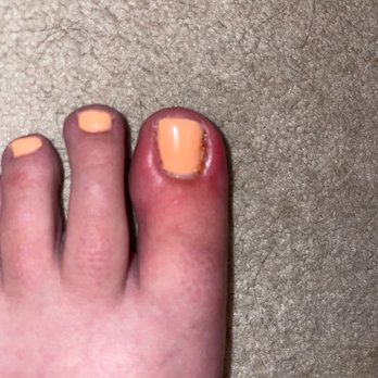 Lacquer Nail Spa - Infected toe - Nail Salons Near Me - Wichita, Kansas