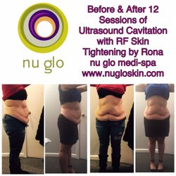 Nu Glo Skin & Laser Spa - Cavi-Lipo with RF Skin Tightening at nu glo! Completely non-invasive! Get summer ready NOW!