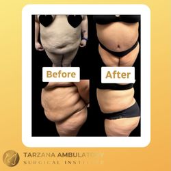 Tarzana Ambulatory Surgical Institute - Tummy Tuck. We accept patients with high BMI's.
