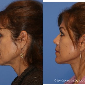 Dr Jay Calvert Plastic Surgery - Facelift and Necklift by Dr Jay Calvert, Beverly Hills - Cosmetic Surgeons Near Me - Newport Beach, California Dr Jay Calvert Plastic Surgery - Facelift and Necklift by Dr Jay Calvert, Beverly Hills - Cosmetic Surgeons Near Me - Newport Beach, California