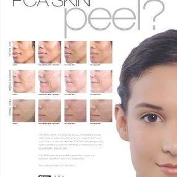 Lemon & Lavender - Realistic expectations from PCA Skin's chemical peels. - Day Spas Near Me - Dalton, Georgia Lemon & Lavender - Realistic expectations from PCA Skin's chemical peels. - Day Spas Near Me - Dalton, Georgia