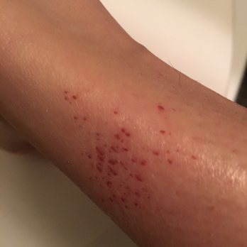 M&A Nails - This is what my lower leg looks like 3 days later from her putting callous remover up towards my ankle. She had no idea what she was doing. - Hair Salons Near Me - Van Nuys, California M&A Nails - This is what my lower leg looks like 3 days later from her putting callous remover up towards my ankle. She had no idea what she was doing. - Hair Salons Near Me - Van Nuys, California