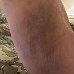 Pacific Diagnostic Laboratories - Blood draw bruise