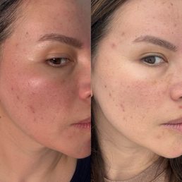 On the left after pico on the right before pico