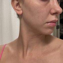 Ary Krau, MD - Nose after surgery.