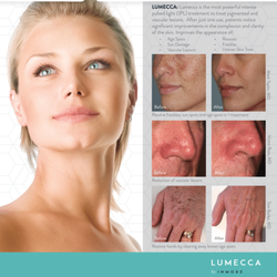 Sandy Key Med Spa - Lumecca for all types of skin conditions, call today for a free consultation.