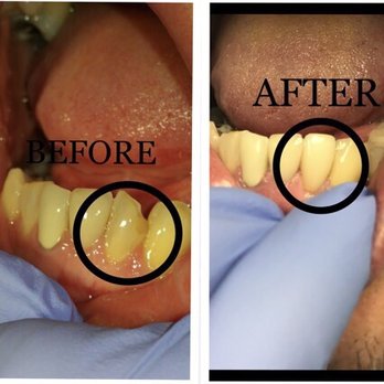 Wayman Tang ,DDS - Before: patient has a chipped and out of alignment tooth. After: crown was placed matched other teeth in color and more aligned - Oral Surgeons Near Me - Castro Valley, California Wayman Tang ,DDS - Before: patient has a chipped and out of alignment tooth. After: crown was placed matched other teeth in color and more aligned - Oral Surgeons Near Me - Castro Valley, California
