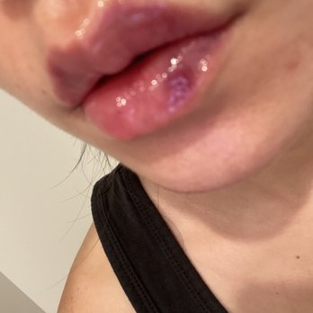 Spa De La Peau - They look gorgeous! (I have very sensitive skin so I get bruises easily) - Medical Spas Near Me - Los Angeles, California Spa De La Peau - They look gorgeous! (I have very sensitive skin so I get bruises easily) - Medical Spas Near Me - Los Angeles, California