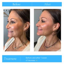 SILK, A Medical Spa - Before and after Jeuveau! Amazing results for a full face and neck treatment to help smooth fine lines and rejuvenate the skin!