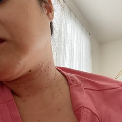 Advanced Institute of Dermatology - Right after the treatment.