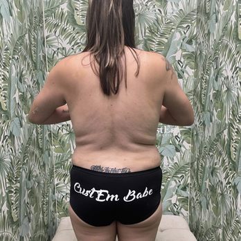 CustEm Aesthetics - Before my seesion - Body Contouring Near Me - Fremont, California CustEm Aesthetics - Before my seesion - Body Contouring Near Me - Fremont, California