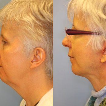Lee Facial Plastic Surgery - Before and After from Lee Facial Plastic Surgery | Boston, MA - Plastic Surgeons Near Me - Boston, Massachusetts Lee Facial Plastic Surgery - Before and After from Lee Facial Plastic Surgery | Boston, MA - Plastic Surgeons Near Me - Boston, Massachusetts