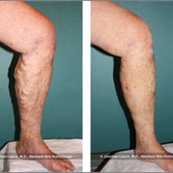 Precision Surgery and Advanced Vein Therapy - Before and After - Surgeons Near Me - Glendale, Arizona Precision Surgery and Advanced Vein Therapy - Before and After - Surgeons Near Me - Glendale, Arizona