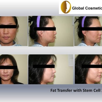 Global Cosmetic Clinic - See the changes? - Cosmetic Surgeons Near Me - Santa Clara, California Global Cosmetic Clinic - See the changes? - Cosmetic Surgeons Near Me - Santa Clara, California