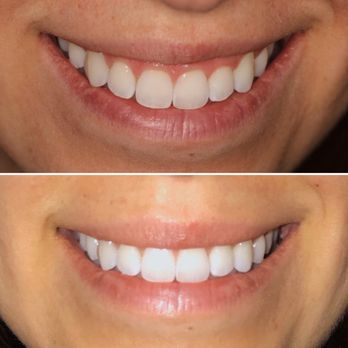 Monica Kieu, DO FACS - Upper lip botox to treat a gummy smile. I couldn't be happier. - Cosmetic Surgeons Near Me - Beverly Hills, California Monica Kieu, DO FACS - Upper lip botox to treat a gummy smile. I couldn't be happier. - Cosmetic Surgeons Near Me - Beverly Hills, California