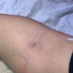 Labcorp - The bruising around the area she was twirling her needle