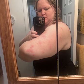 Hampton Inn Indianapolis Downtown Across from Circle Centre - Bed bug bites - Hotels Near Me - Indianapolis, Indiana Hampton Inn Indianapolis Downtown Across from Circle Centre - Bed bug bites - Hotels Near Me - Indianapolis, Indiana