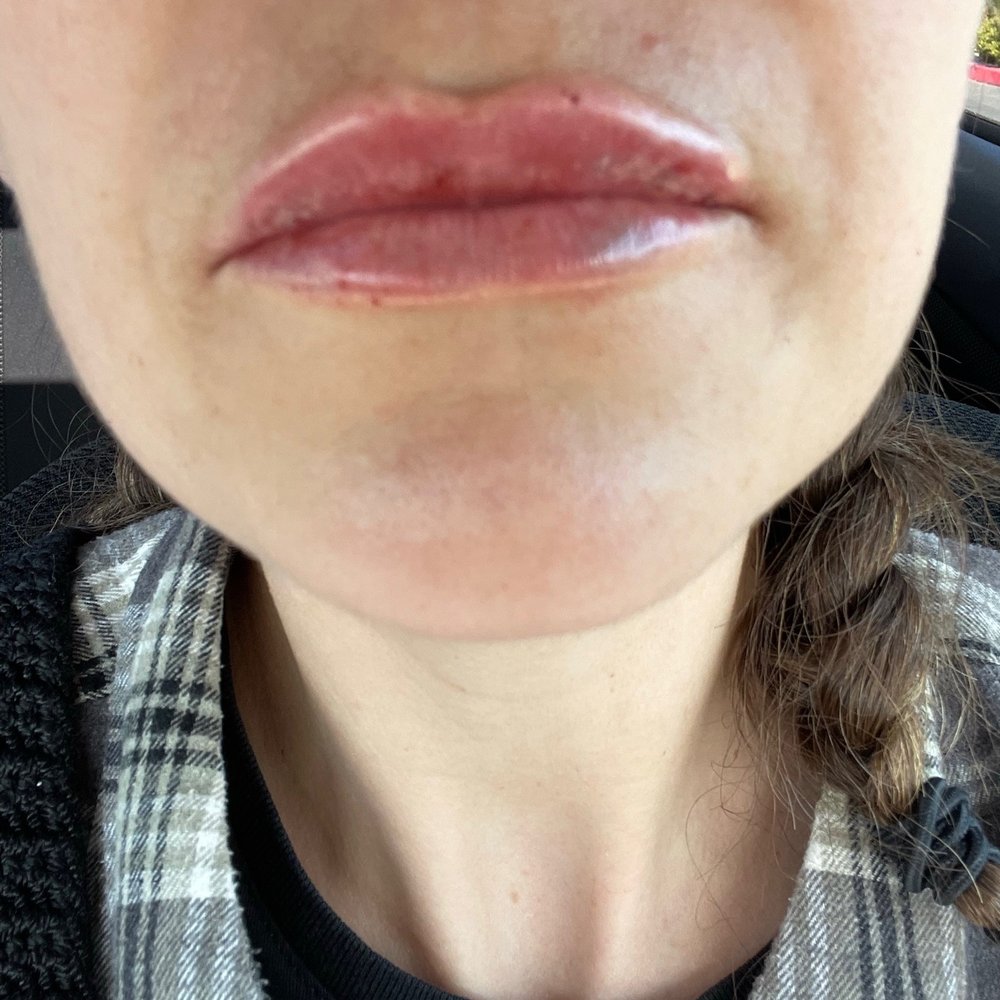 LaserAway - Immediately after - Medical Spas Near Me - Fresno, California LaserAway - Immediately after - Medical Spas Near Me - Fresno, California